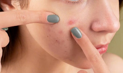 Tỏi giúp trị mụn trứng cá. Nguồn ảnh: Pexels