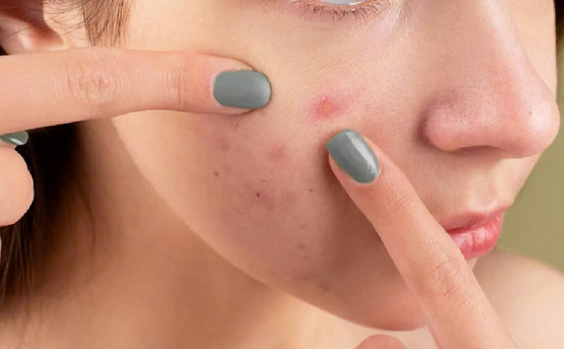 Tỏi giúp trị mụn trứng cá. Nguồn ảnh: Pexels