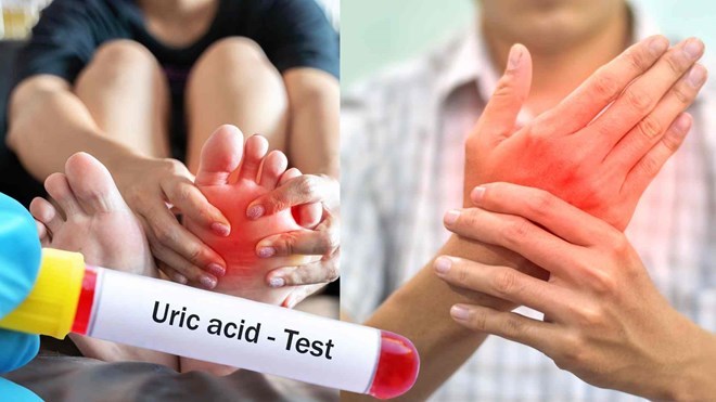 Những dấu hiệu bất thường ở da chứng tỏ axit uric tăng cao