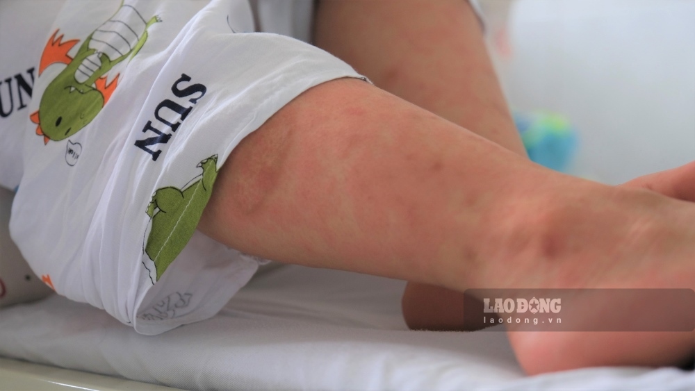 Measles symptoms on the skin of a child. Photo: BVCC