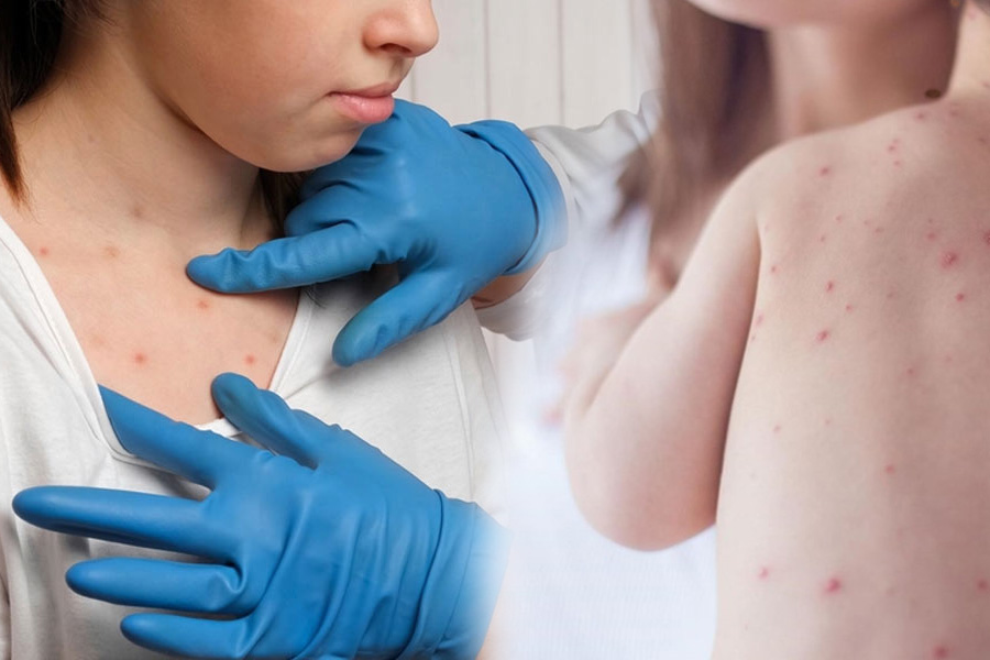 Trẻ em dễ mắc bệnh bệnh đậu mùa khỉ hơn người lớn. Đồ họa: Thiện Nhân