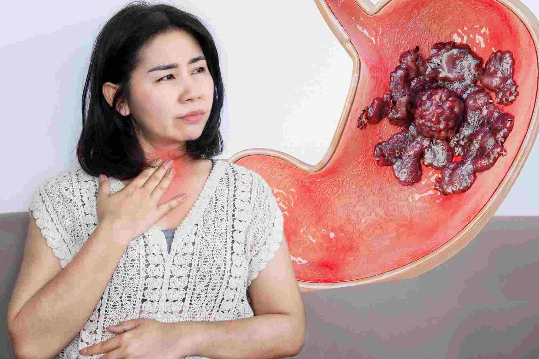 5 mẹo tránh trào ngược axit dạ dày hiểu quả trong giao mùa.