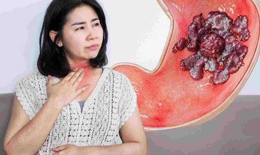 5 mẹo tránh trào ngược axit dạ dày hiểu quả trong giao mùa.