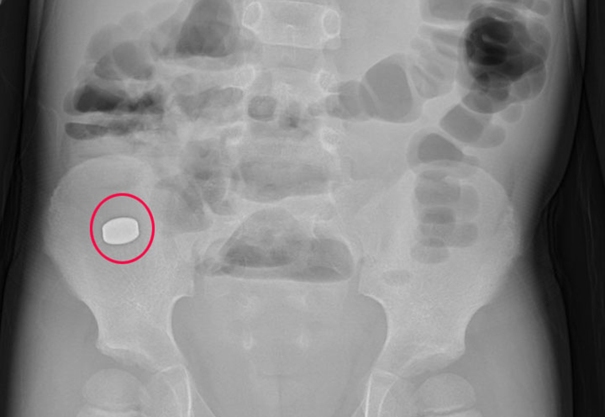 Kết quả chụp X-quang, xác định cục nam châm trong đường tiêu hóa vị trí tại hố chậu phải của bệnh nhi ở Quảng Ninh. Ảnh: Bệnh viện cung cấp