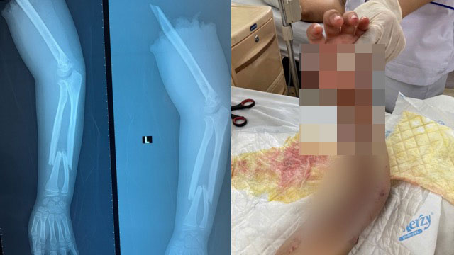 Bệnh nhi bị đứt lìa cánh tay trái được nối thành công. Ảnh: BVCC