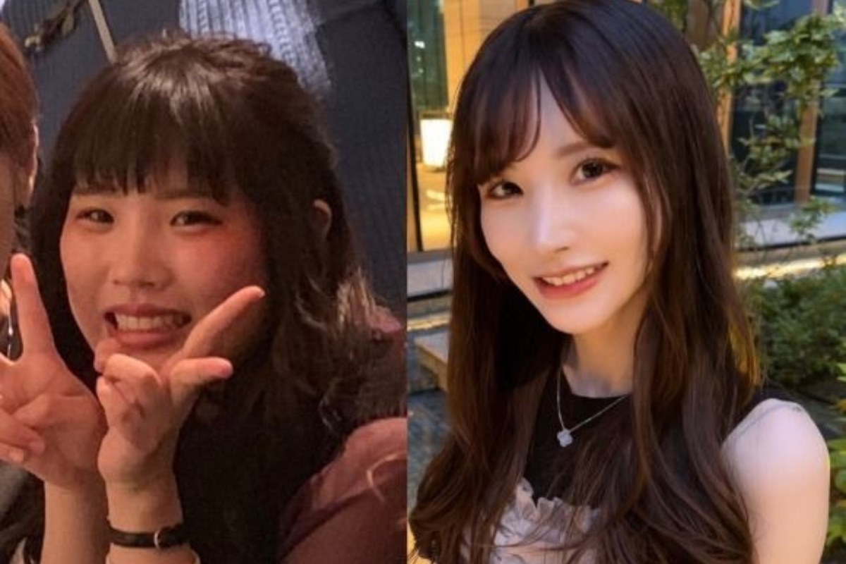 Lara's before and after plastic surgery photos. Photo: Daum