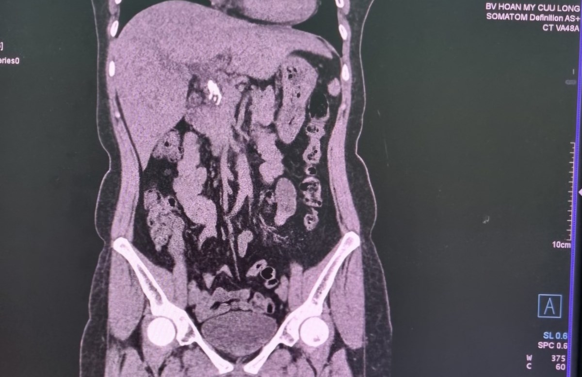 As a result of MSCT, the patient had many molded stones filling the common bile duct and gallbladder. Photo: Provided by the hospital