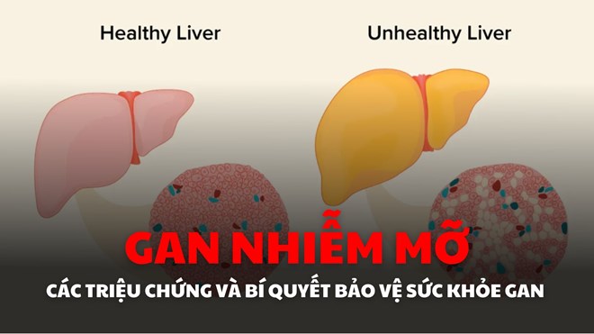 Gan nhiễm mỡ - Các triệu chứng và bí quyết bảo vệ gan