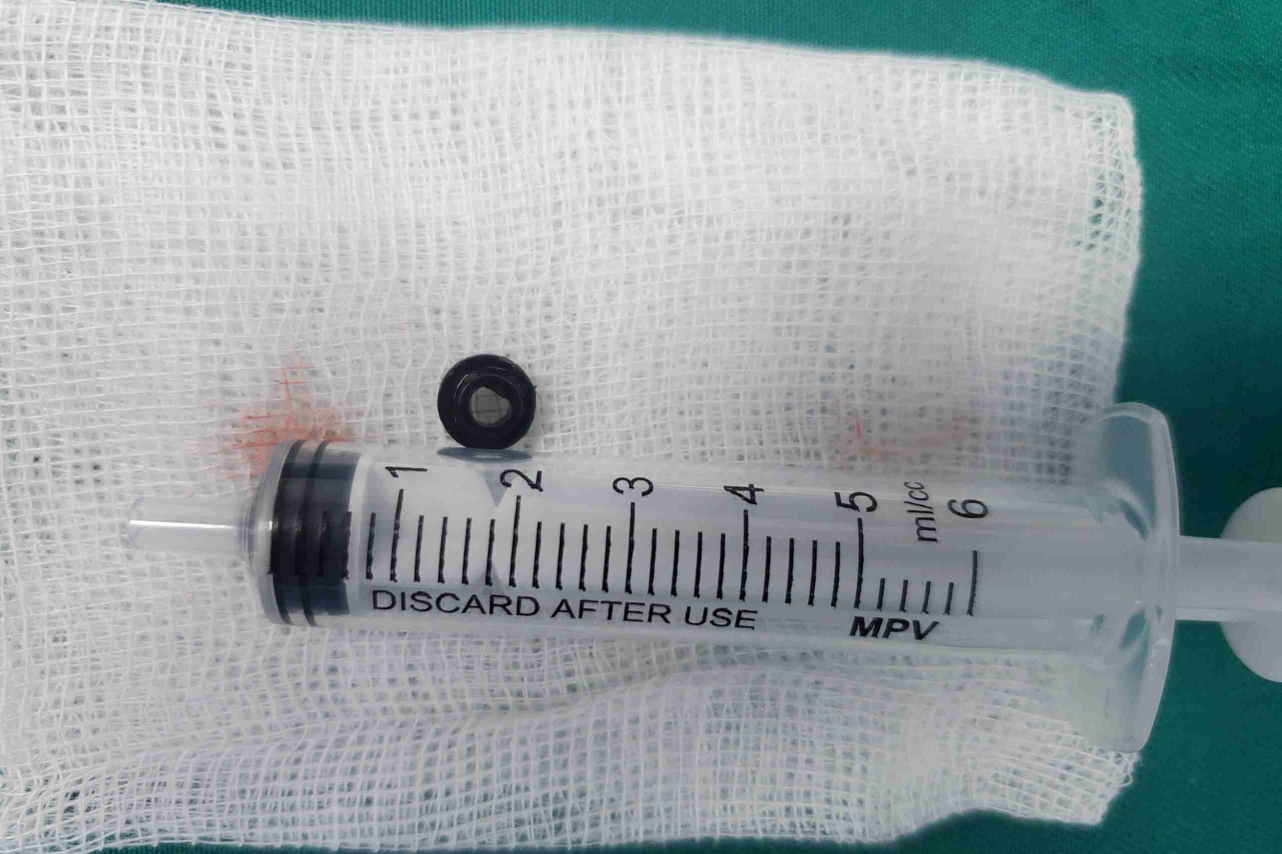 Dị vật rơi sâu vào phế quản gốc của trẻ. Ảnh: Cổng TTĐT Hải Phòng