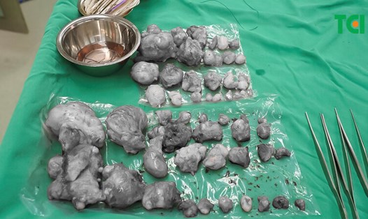 60 u xơ được bóc tách thành công. Ảnh: BVCC