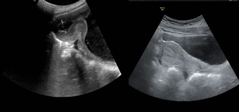 Hình ảnh siêu âm trước khi phẫu thuật cho thấy trong buồng tử cung có dịch dày 11mm, niêm mạc dày 9mm. Ảnh: BVCC