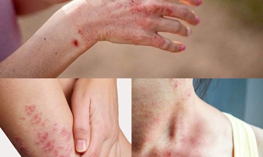 Viêm da, ghẻ lở, nấm chân tay... là các bệnh về da thường gặp phải sau mưa lũ. Ảnh đồ họa: Hương Giang