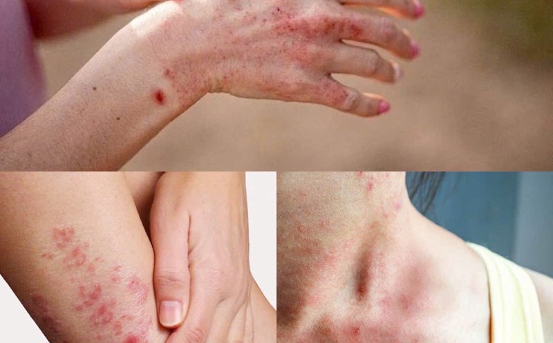 Viêm da, ghẻ lở, nấm chân tay... là các bệnh về da thường gặp phải sau mưa lũ. Ảnh đồ họa: Hương Giang