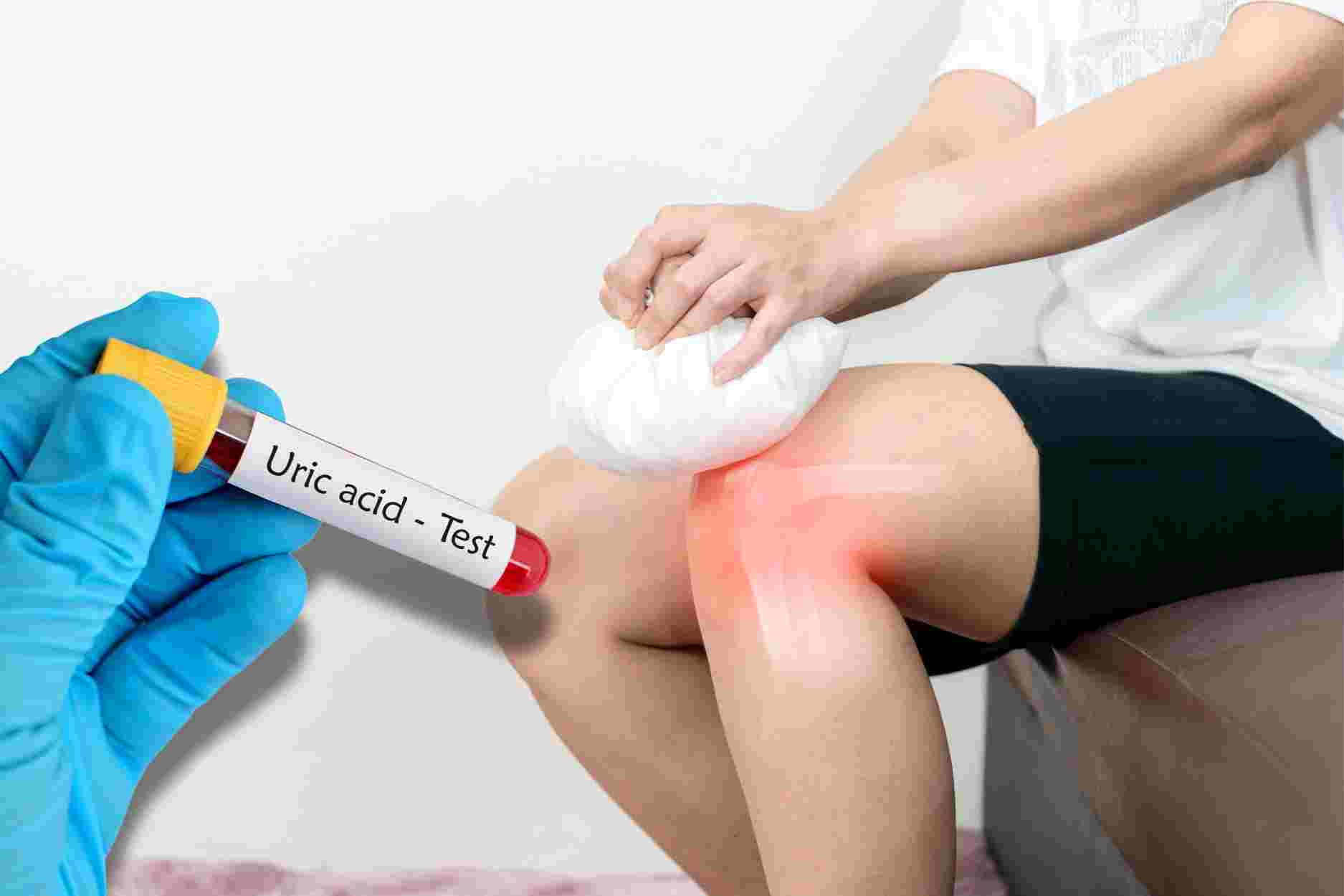 3 cách giảm đau bệnh gút, đào thải axit uric nhanh chóng