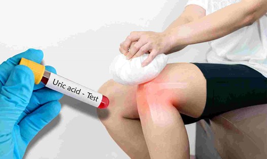 3 cách giảm đau bệnh gút, đào thải axit uric nhanh chóng