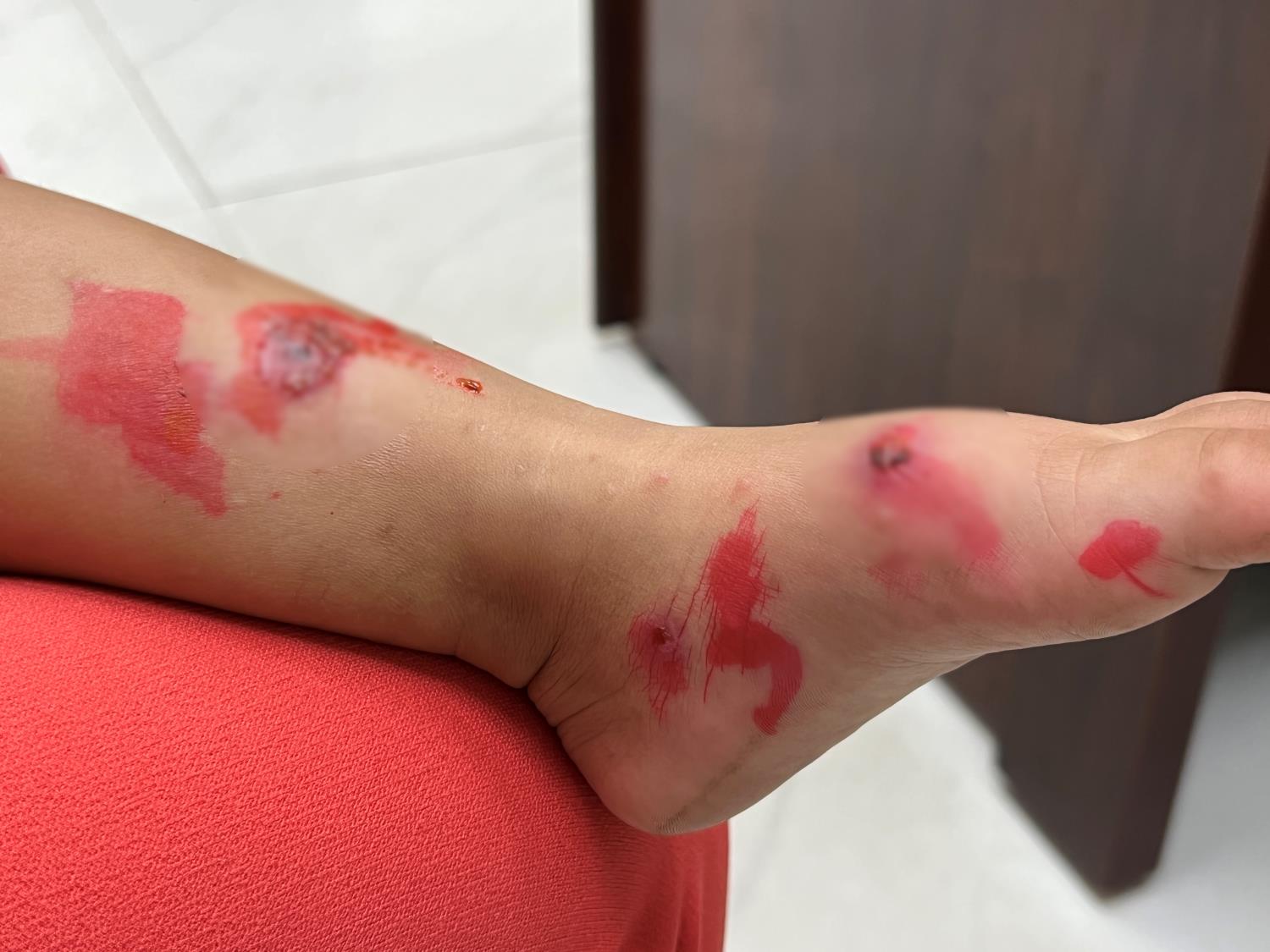 Đi học trở lại, cảnh báo bệnh chốc lây lan nhanh ở trẻ