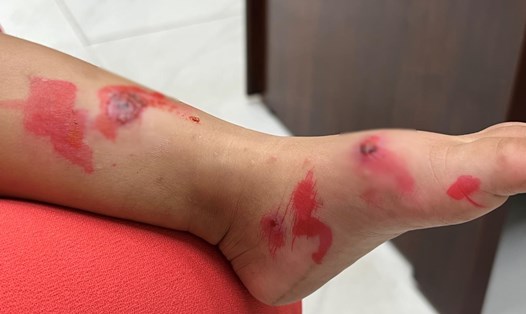 Đi học trở lại, cảnh báo bệnh chốc lây lan nhanh ở trẻ