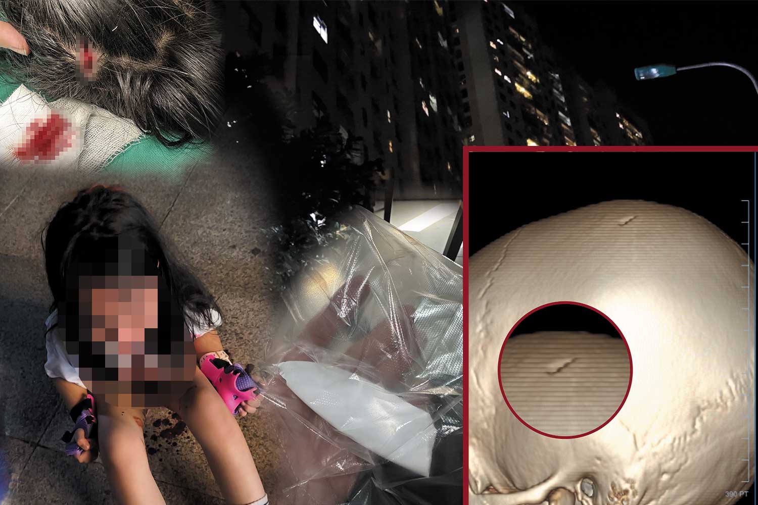 Chơi dưới chung cư, bé gái bị vật cứng rơi trúng, lõm sọ não