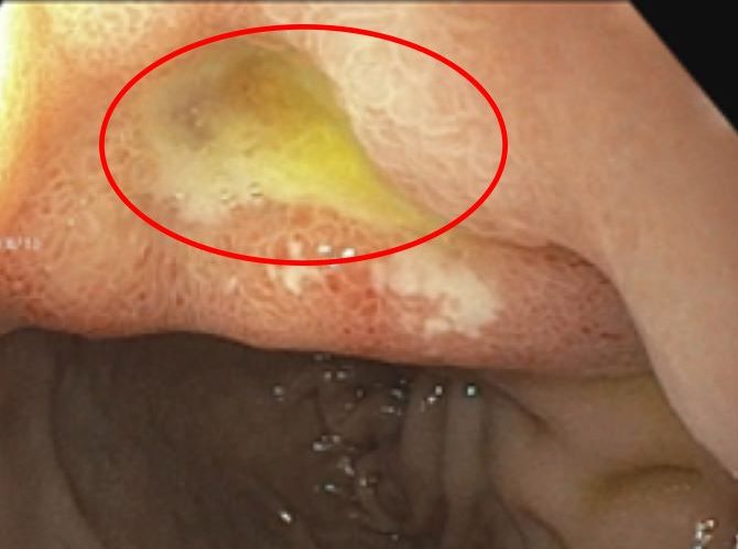 Stomach ulcer on a patient's digestive endoscopy image. Photo: BVCC