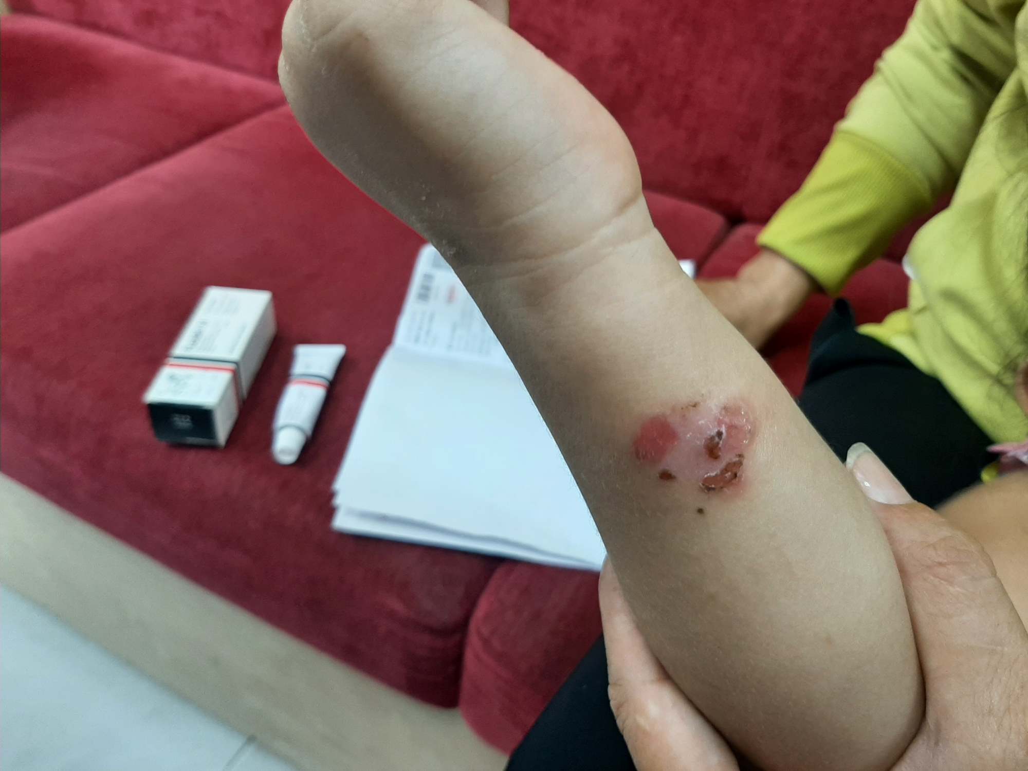 If diagnosed early and treated properly, children with impetigo will recover quickly and without scarring. Photo: Provided by the hospital