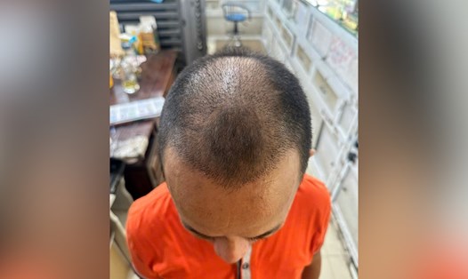 Phần tóc của anh H đã mọc sau 3 tuần được cấy tóc. Ản: NVCC