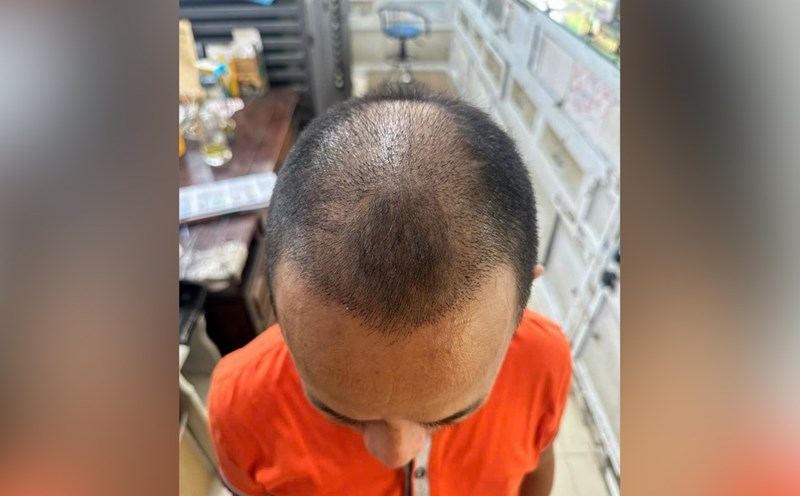 Mr. H's hair has grown after 3 weeks of hair transplant. Photo: NVCC