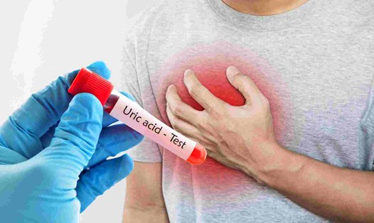 Nồng độ axit uric cao ảnh hưởng ra sao tới bệnh tim mạch?
