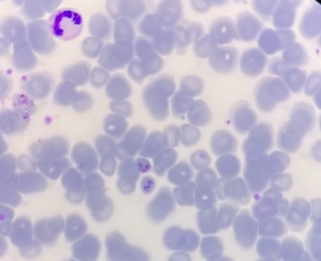 Test results of a patient with malaria. Photo: CDC Quang Binh