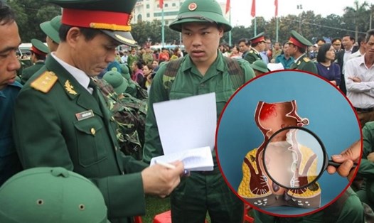 Bị bệnh trĩ có được miễn nghĩa vụ quân sự không?