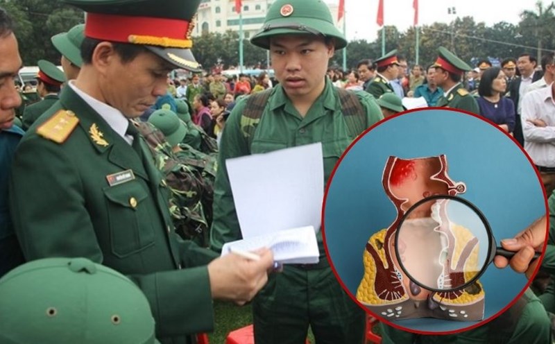 Are hemorrhoids exempt from military service?