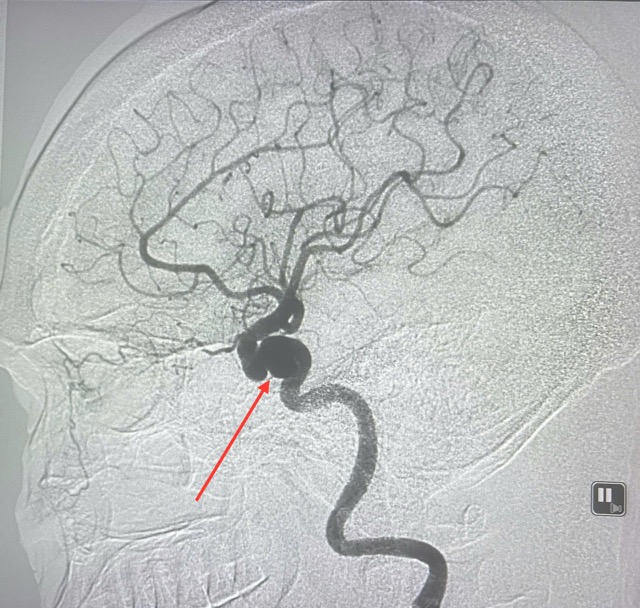 Túi phình mạch máo não của bệnh nhân. Ảnh: BVCC