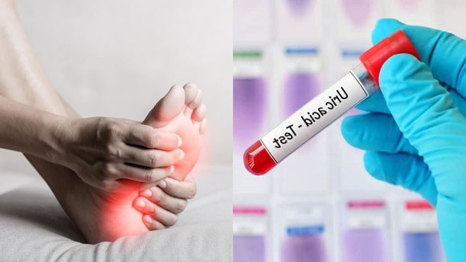 High uric acid levels can come from internal factors or an unhealthy diet and lifestyle. Graphics: Thuy Dung
