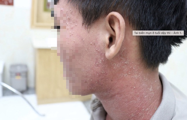 Một bệnh nhân sau khi mua sản phẩm chăm sóc da trên mạng bị lột da quá mức. Ảnh: BVCC