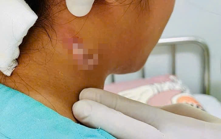 Bé gái 14 tuổi ở Đồng Nai nhiễm "vi khuẩn ăn thịt người" tại Đồng Nai. Ảnh: HAC