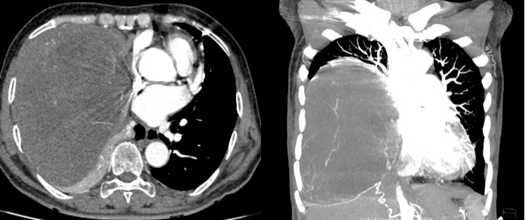 Hình ảnh khối u ở phổi của bệnh nhân. Ảnh: BVCC 