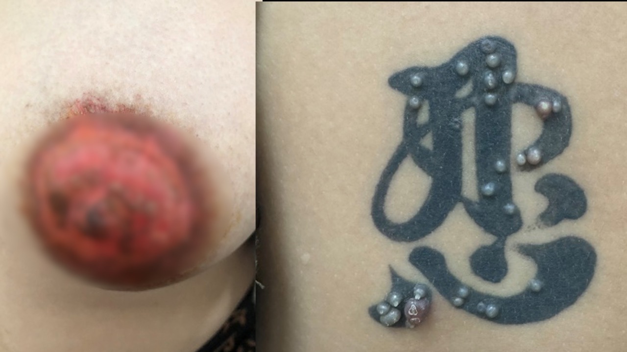 Tattoo patient suffers infection. Photo: BSCC
