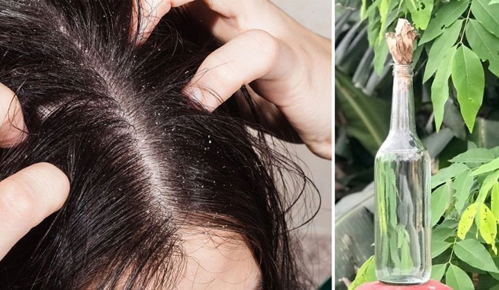 Bỏng giác mạc do ủ chấy bằng rượu ngâm hạt na. Ảnh minh hoạ BVCC