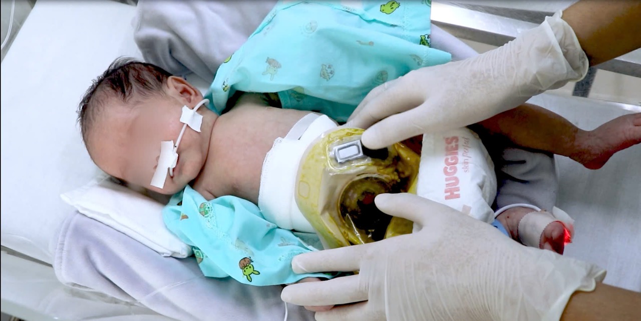 Bệnh nhi được cấp cứu thành công. Ảnh: BVCC