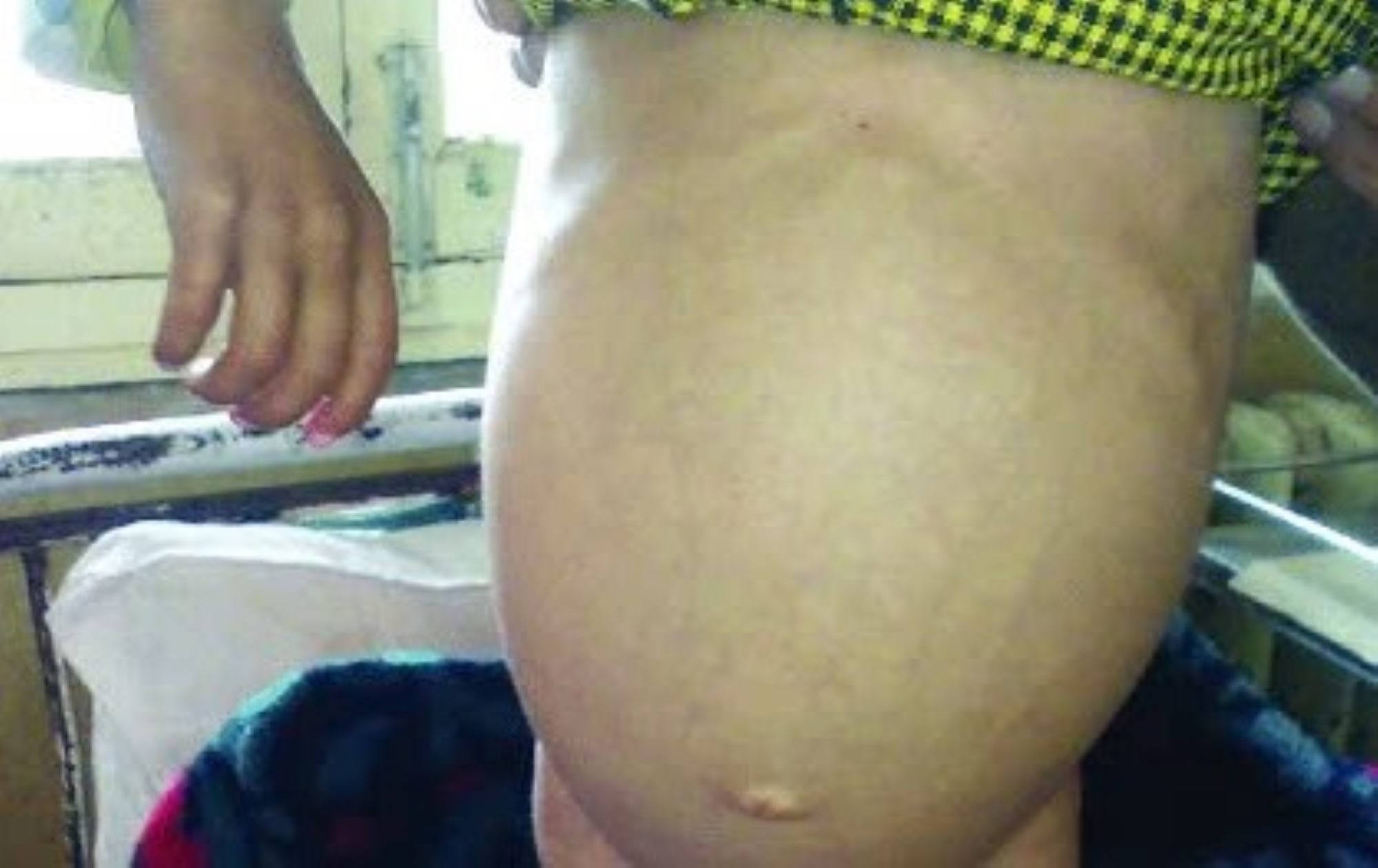 The patient's abdomen was distended due to feces stagnation in the colon. Photo: Provided by Children's Hospital 2