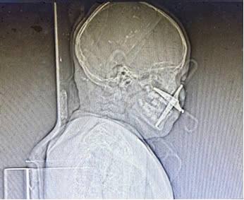 Image of scissors stabbing into patient's face before surgery. Photo: BVCC