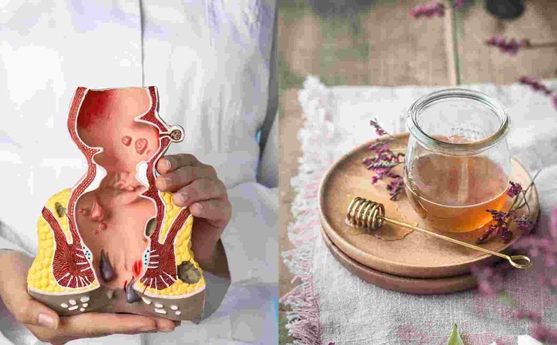 Honey water helps reduce hemorrhoids. Graphics: Ha May