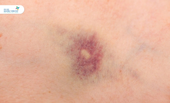 One of the signs of a tibia fracture is bruising and bluish discoloration of the injured leg. Photo: Provided by the hospital