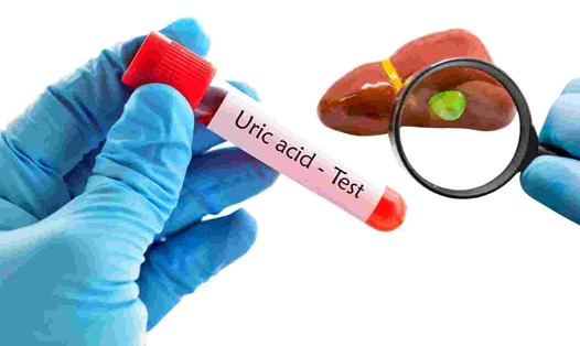 Axit uric cao có tác động đến túi mật, gan và thận. Đồ họa: Hạ Mây