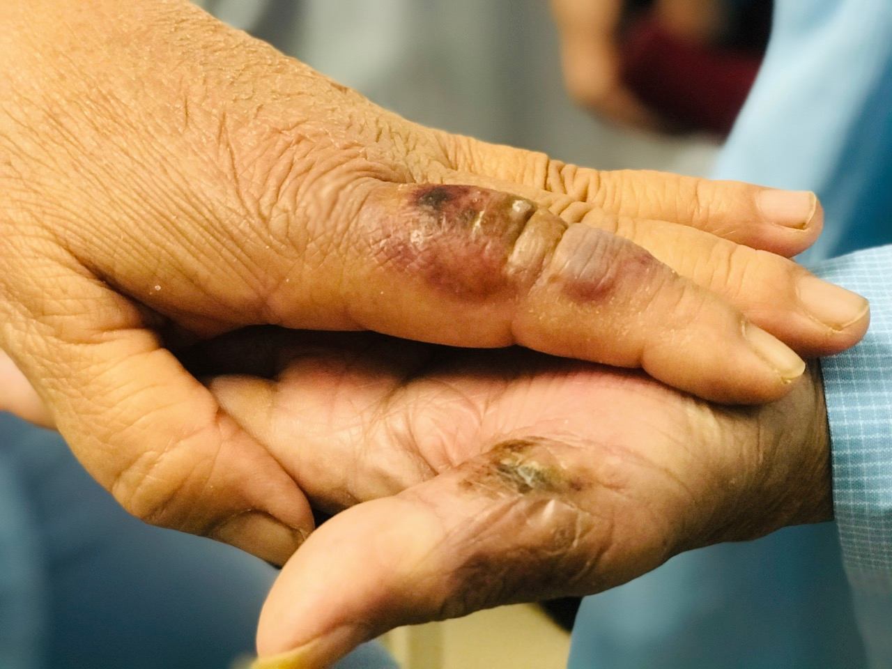 The rat bite on the patient's hand was swollen and edematous after being hospitalized and has gradually healed. Photo: Thuy Duong