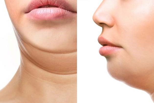Mỡ thừa ở cổ gây ra vấn đề về hô hấp như thế nào?