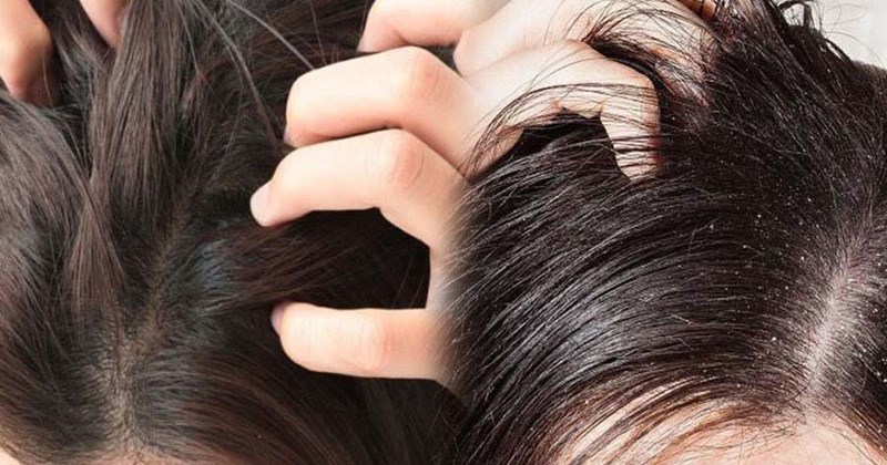 Head Scal Typical scalp types and appropriate care