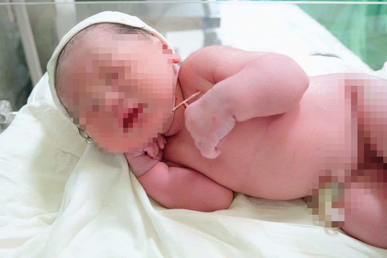 Baby girl born with IUD her mother had placed 2 years earlier. Photo: BVCC