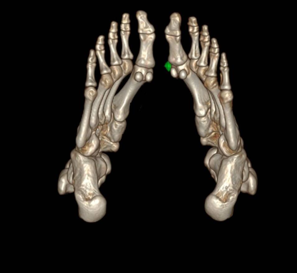CT scan shows urate crystal deposits in the first metatarsal joint of the patient's left foot. High uric acid levels in the blood are the direct cause of the formation of urate crystals. Photo: BVCC