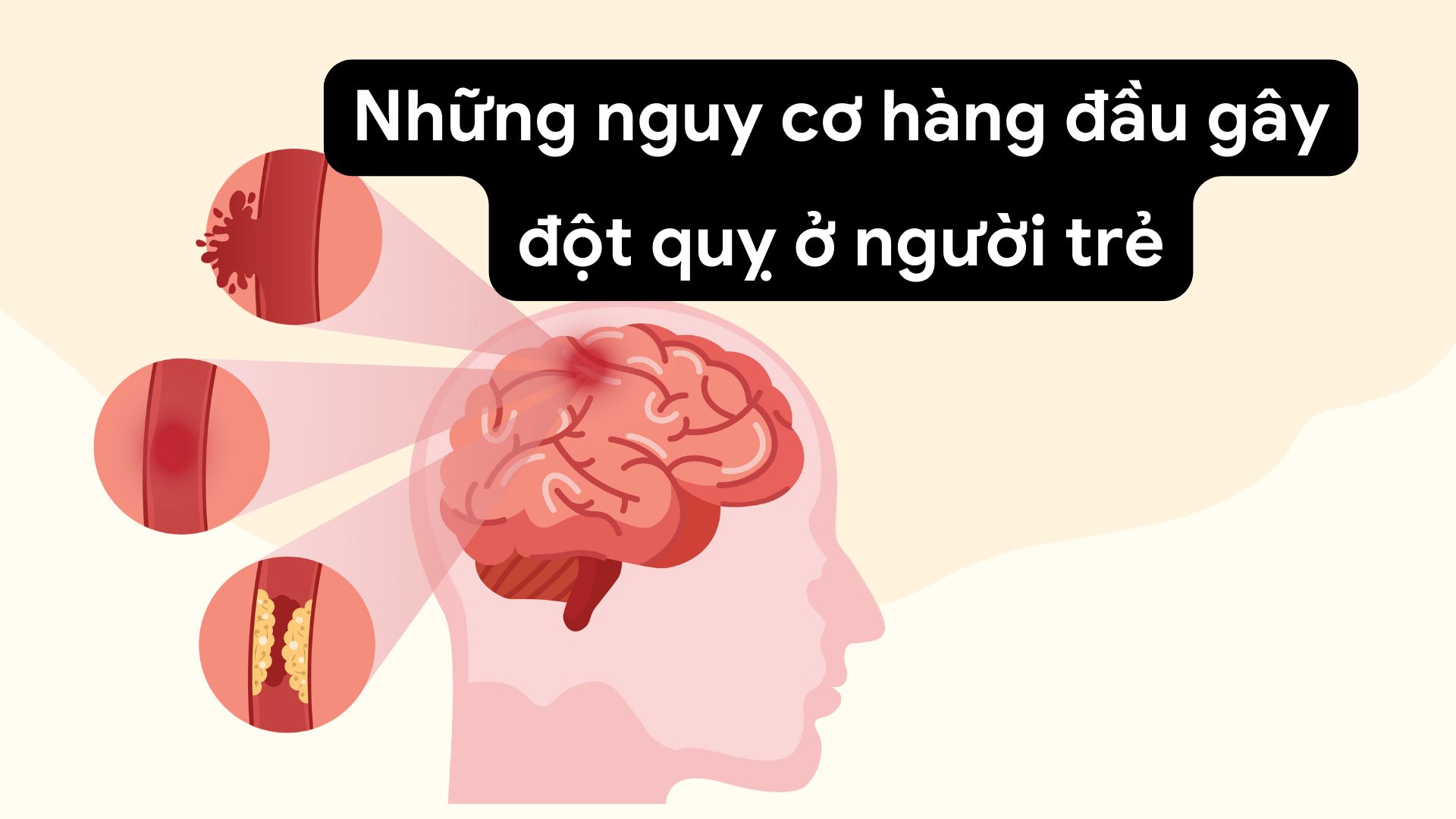 Prolonged stress increases the rate of stroke. Photo collage: HUONG SON