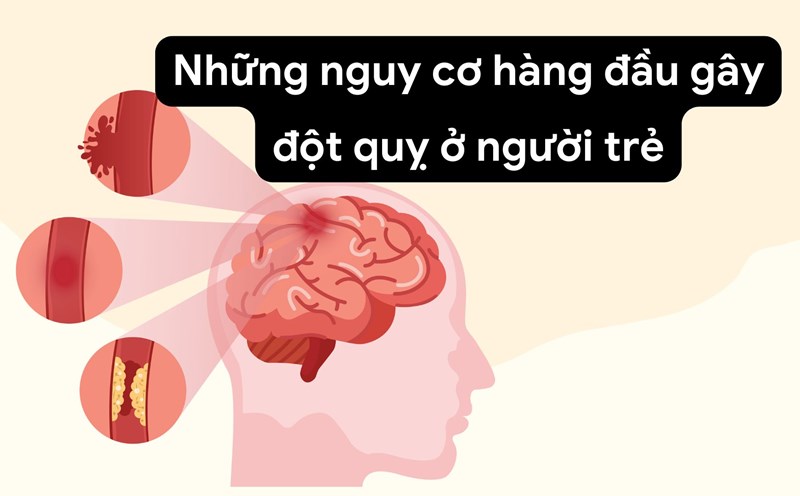 Prolonged stress increases the rate of stroke. Photo collage: HUONG SON